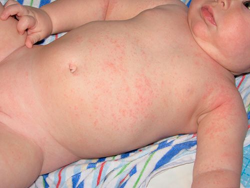 Как ухаживать за кожей малыша летом: лечение опрелостей, потницы и дерматита