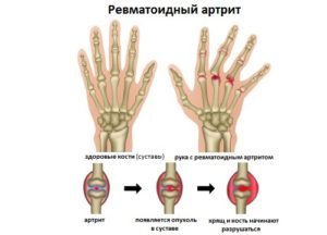 revmatoidnyy-artrit