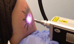 Уход за татуировкой после сеанса лазерного осветления