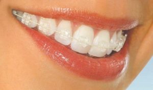 В каких случаях и как ставят брекеты на зубы?