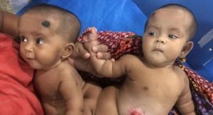 Хирурги разделили сиамских близнецов со сросшимися позвоночниками и прямой кишкой