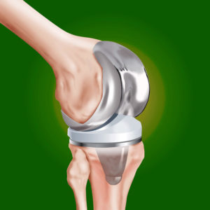 Эндопротезирование коленного сустава – цена на протезы