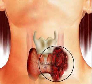 Как вылечить рак щитовидной железы