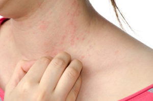 Аллергический дерматит и крапивница на теле как причины покраснения
