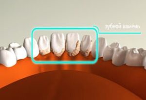 Что представляет собой зубной камень?