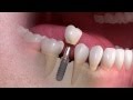 Что можно жевать после имплантации зубов?