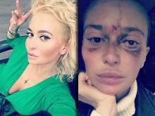 "Умер нерв": москвичка ослепла на один глаз после укола косметолога