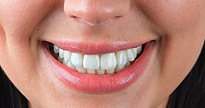 Как выполняется реставрация зубов