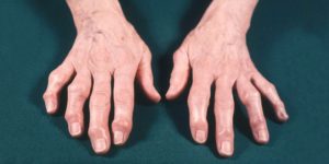 Как диагностировать остеоартроз кистей рук?