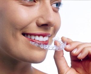 Почему стоматологи рекомендуют элайнеры