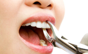 Этапы и особенности удаления зубов