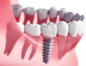 Все особенности имплантации зубов