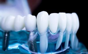Имплантация зубов в EliteDent