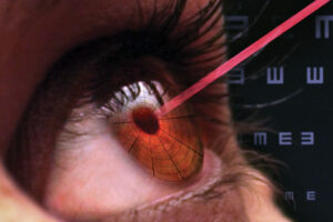 Лечение глаз лазером