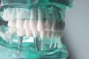 Имплантация зубов: что стоит знать