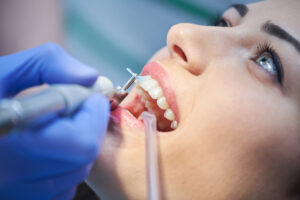Профессиональная чистка зубов: для чего нужно делать, преимущества