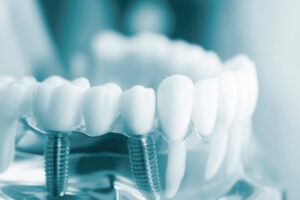 Особенности имплантации зубов: что нужно знать