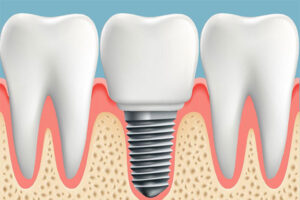 Что стоит знать об имплантации зубов
