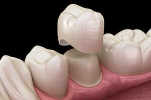 Оттискные материалы, используемые в ортодонтии и протезировании
