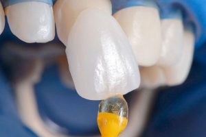 Почему циркониевые виниры не рекомендованы для передних зубов?