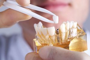 Привыкаем к зубным коронкам: как ускорить привыкание