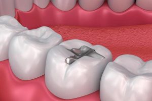 Установка пломб для зубов: когда требуется, особенности