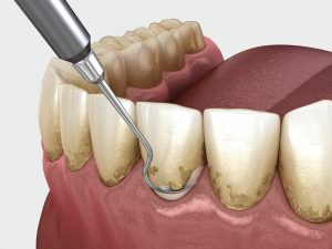 Зубной камень и его воздействие на оральное здоровье
