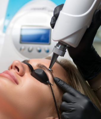 Лазерное удаление татуажа: Прощай, прошлое – здравствуй, чистая кожа!